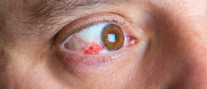 Retinopatia diabética: diagnóstico precoce e cuidados essenciais no Instituto Olhar Premium