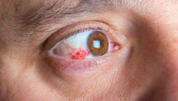 Retinopatia diabética: diagnóstico precoce e cuidados essenciais no Instituto Olhar Premium