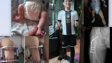 Arthur enfrenta a nona cirurgia e família cria campanha para ajudar no tratamento