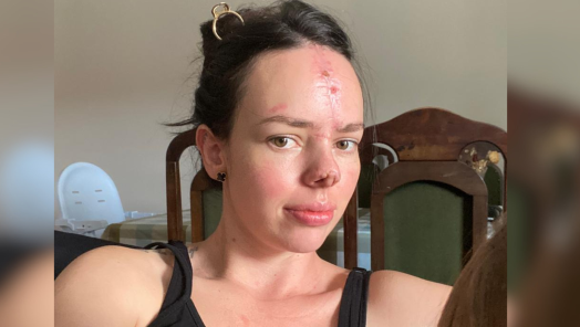 Após perder parte do nariz em acidente, moradora de SC agradece apoio após arrecadar valor para cirurgia reconstrutiva