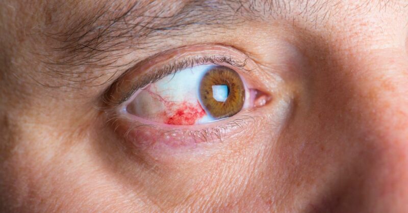 Retinopatia diabética: diagnóstico precoce e cuidados essenciais no Instituto Olhar Premium