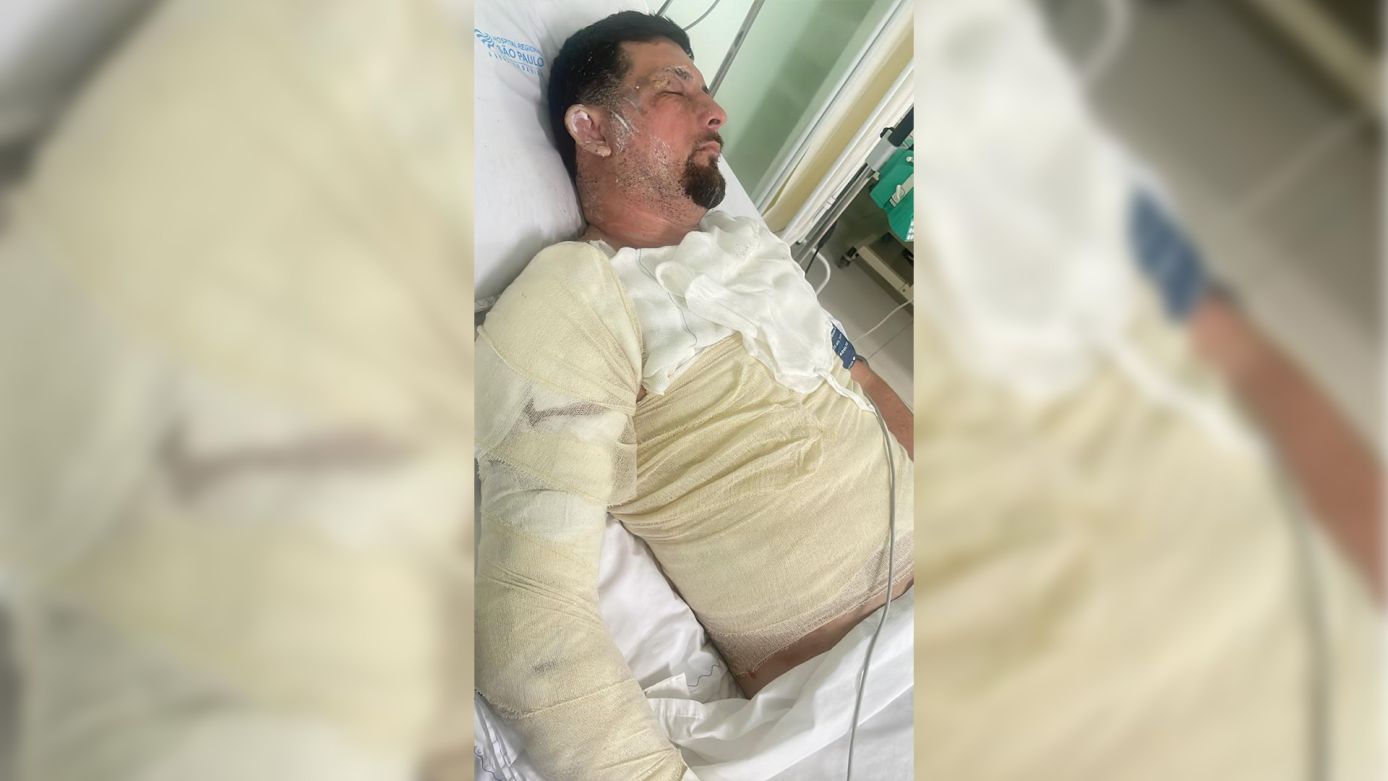 Rifa solidária busca ajudar barbeiro de Xanxerê que teve 30% do corpo queimado