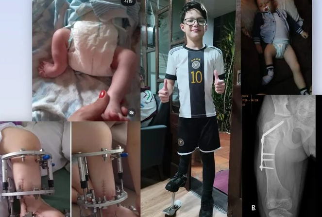 Arthur enfrenta a nona cirurgia e família cria campanha para ajudar no tratamento