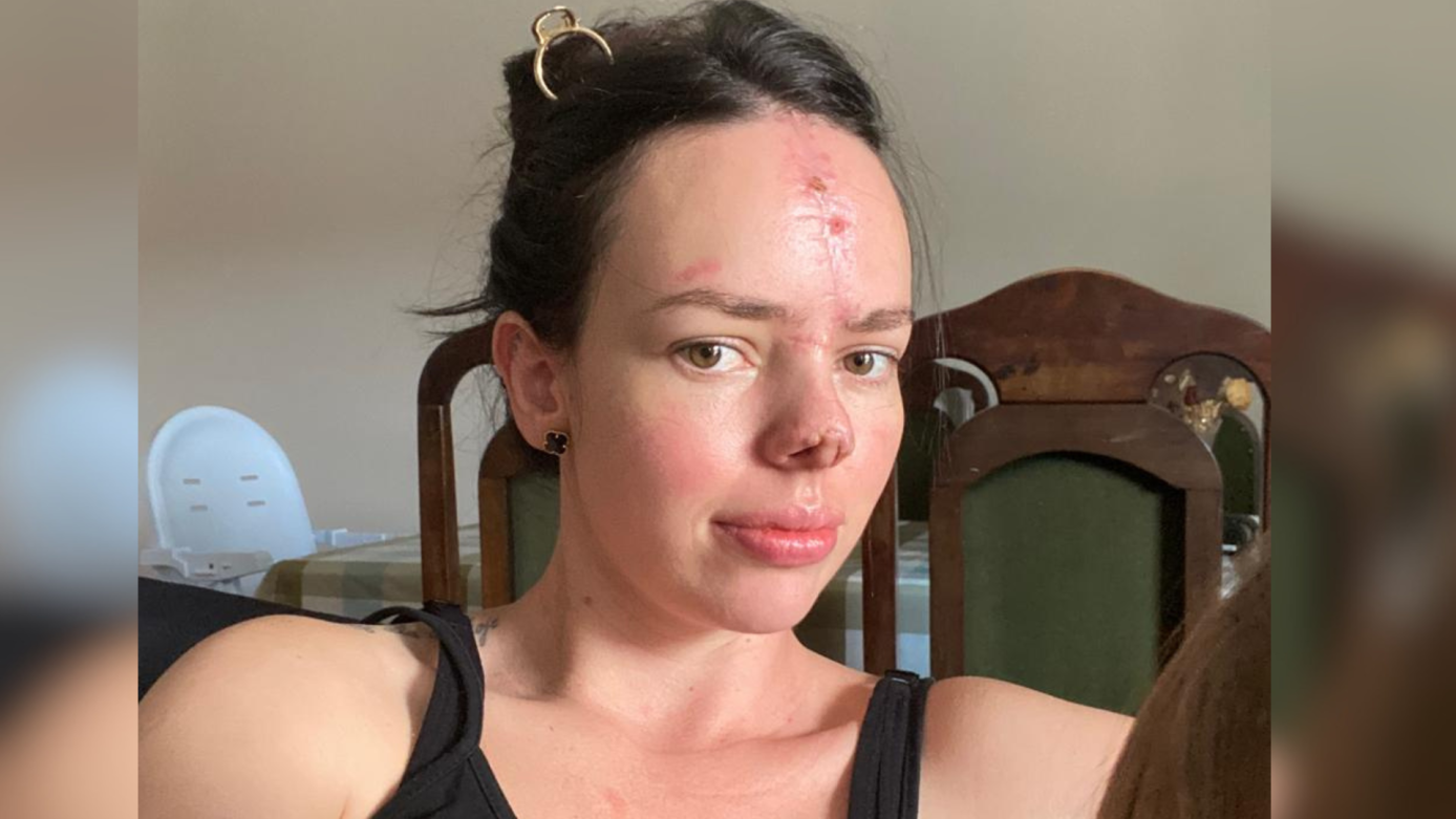Após perder parte do nariz em acidente, moradora de SC agradece apoio após arrecadar valor para cirurgia reconstrutiva