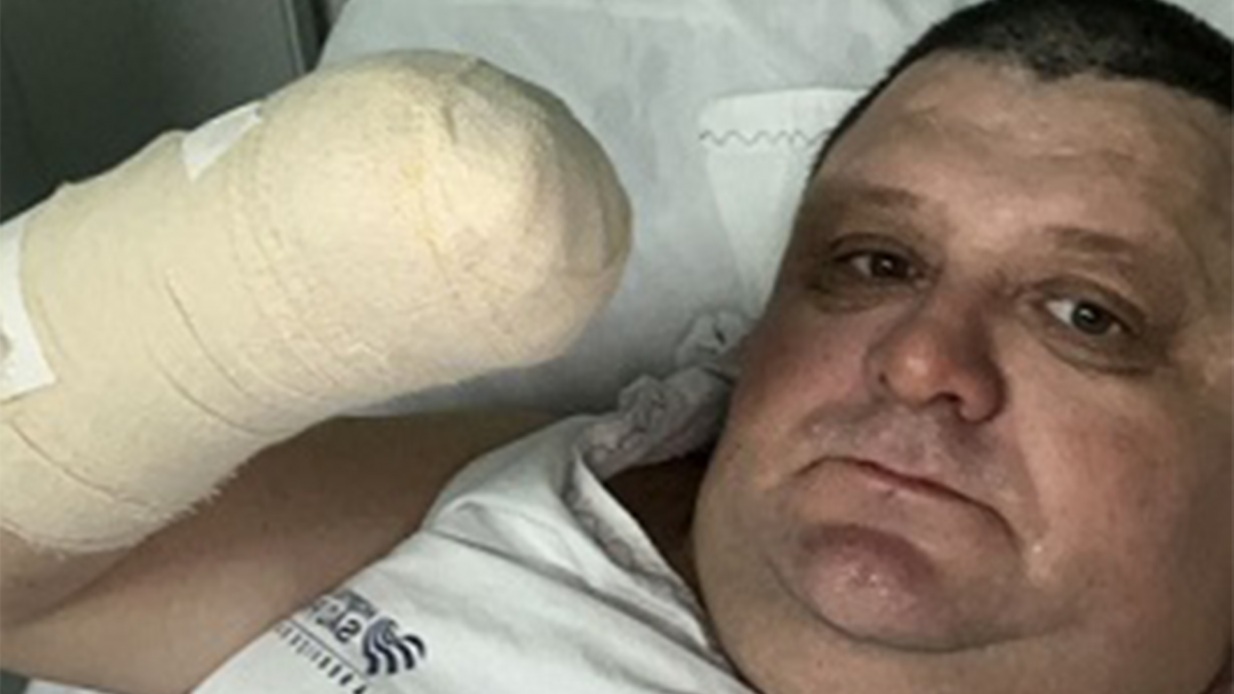 Humorista “Pilha” tem mão amputada após manusear foguete, em Xaxim
