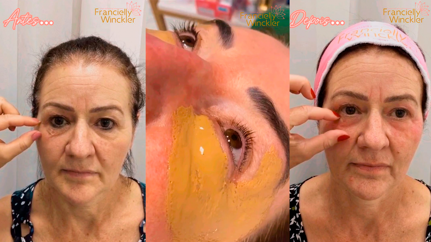 VÍDEO: Descubra a beleza que o Line Skin Hard pode trazer para a sua pele na Clínica FW!